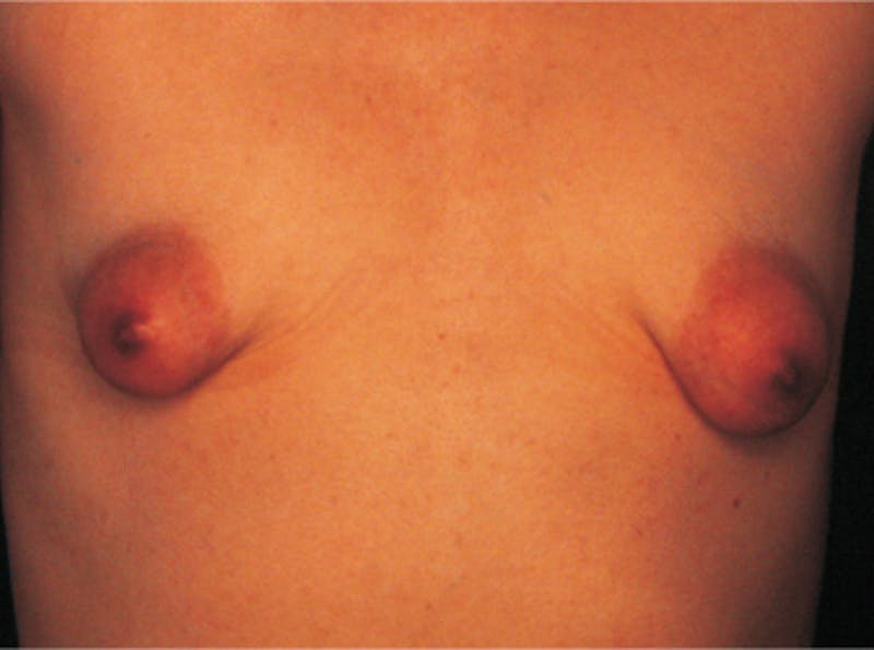 Breast Lift Before & After Gallery - Patient 868664 - Image 1