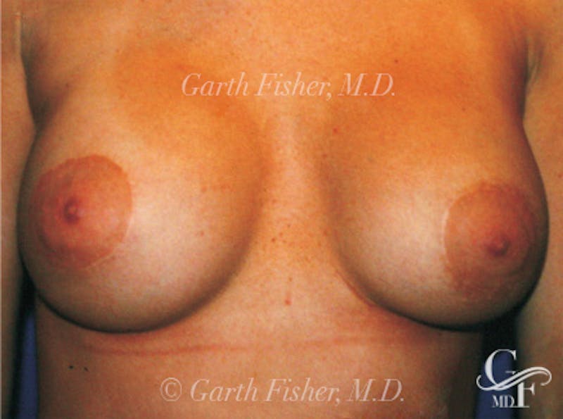 Breast Lift Before & After Gallery - Patient 868664 - Image 2