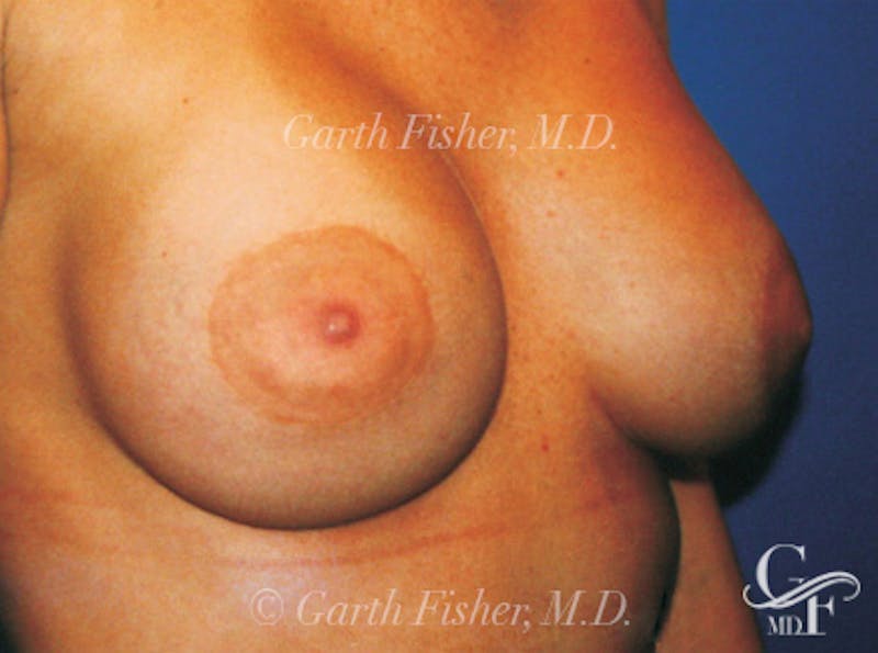 Breast Lift Before & After Gallery - Patient 868664 - Image 4