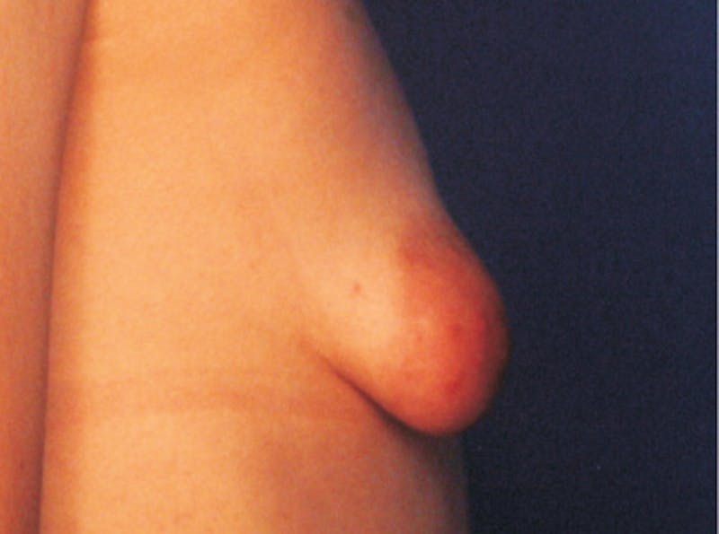 Breast Lift Before & After Gallery - Patient 868664 - Image 5