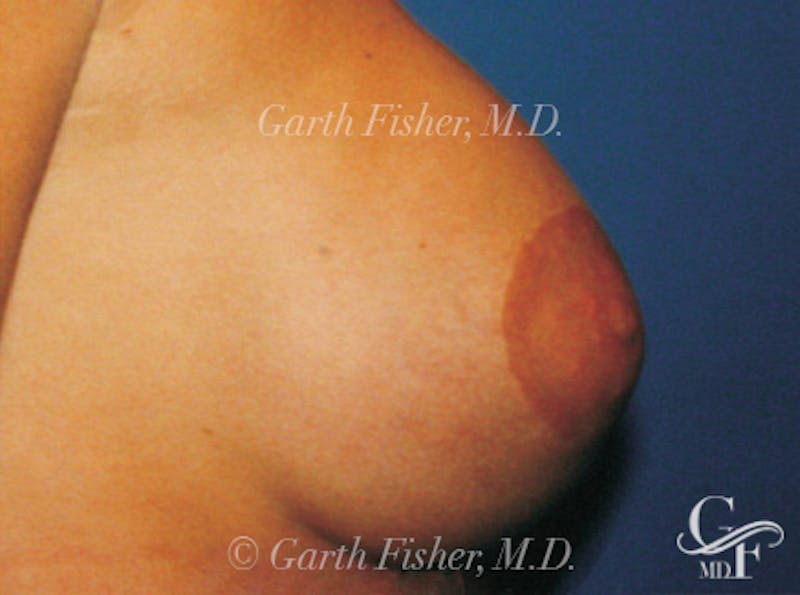 Breast Lift Before & After Gallery - Patient 868664 - Image 6