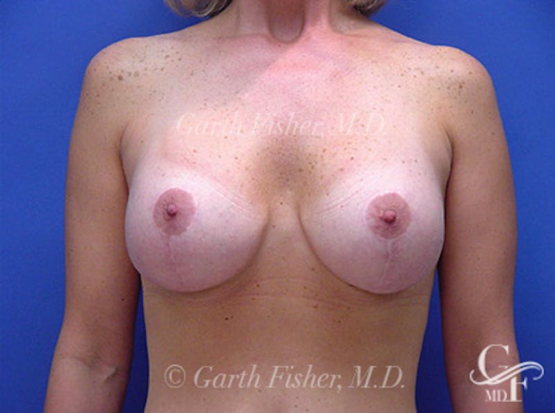 Breast Lift Before & After Gallery - Patient 698945 - Image 2
