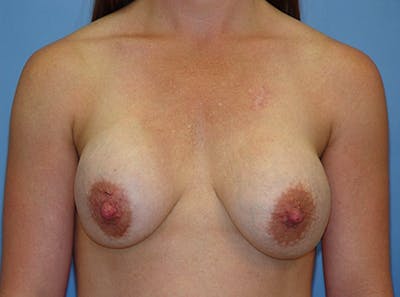 Breast Lift Before & After Gallery - Patient 405436 - Image 1