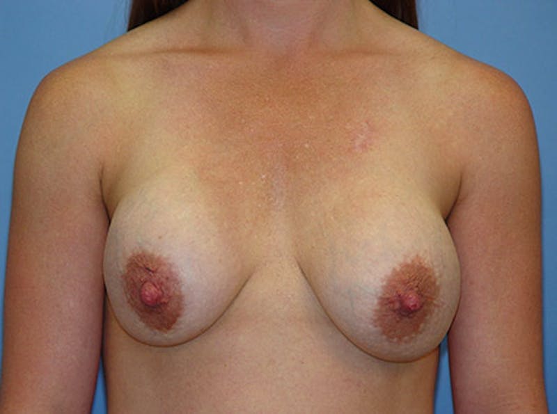 Breast Lift Before & After Gallery - Patient 405436 - Image 1
