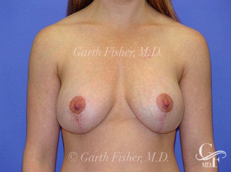 Breast Lift Before & After Gallery - Patient 405436 - Image 2