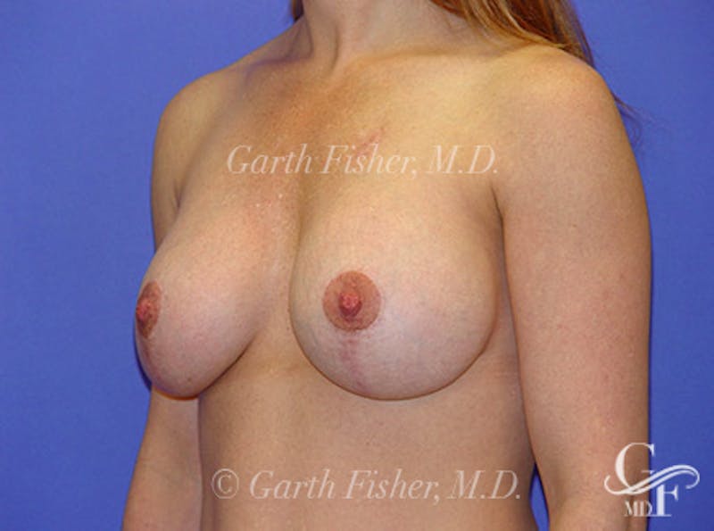 Breast Lift Before & After Gallery - Patient 405436 - Image 4