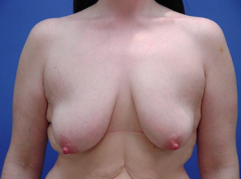 Breast Lift Before & After Gallery - Patient 382769 - Image 1