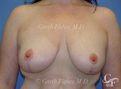 Breast Lift Before & After Gallery - Patient 382769 - Image 2