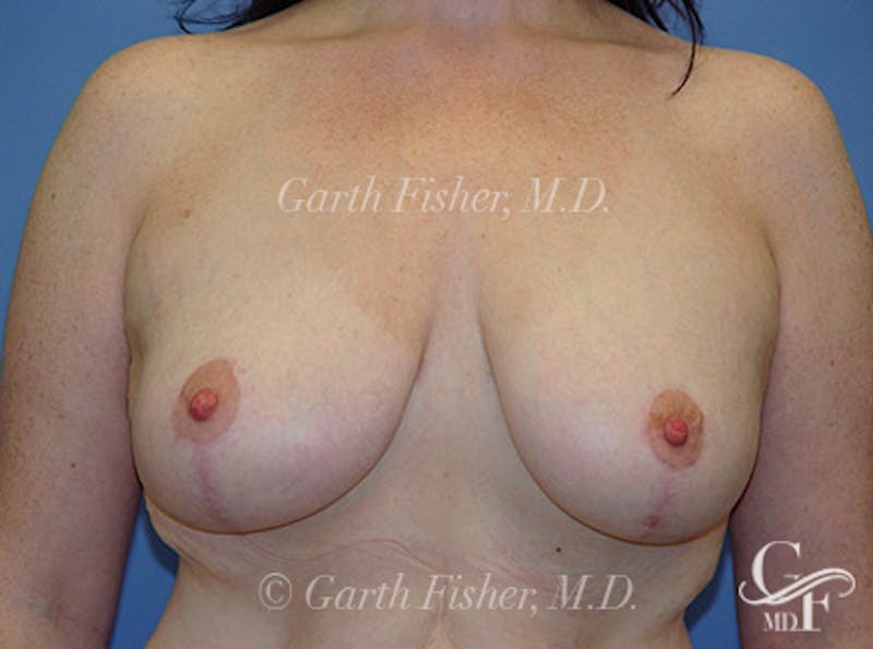 Breast Lift Before & After Gallery - Patient 382769 - Image 2