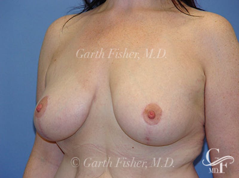 Breast Lift Before & After Gallery - Patient 382769 - Image 4