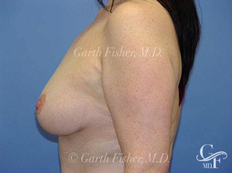 Breast Lift Before & After Gallery - Patient 382769 - Image 6