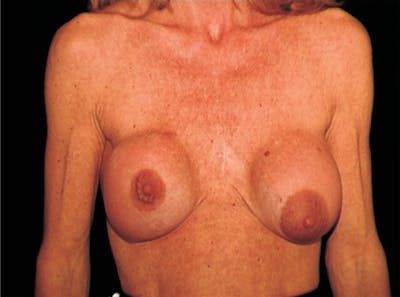 Breast Lift Before & After Gallery - Patient 266841 - Image 1