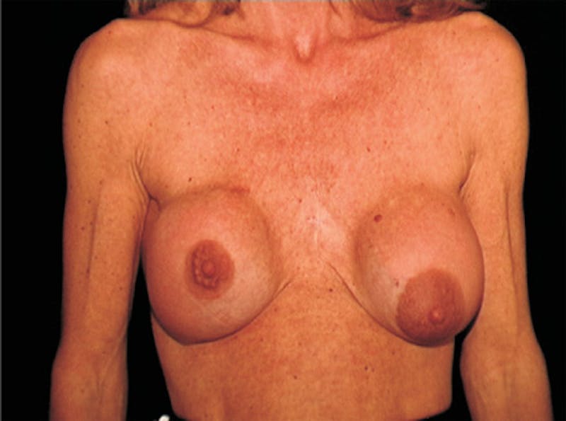Breast Lift Before & After Gallery - Patient 266841 - Image 1