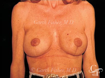 Breast Lift Before & After Gallery - Patient 266841 - Image 2