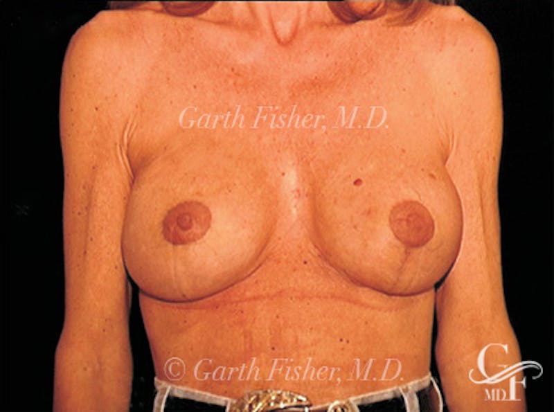 Breast Lift Before & After Gallery - Patient 266841 - Image 2