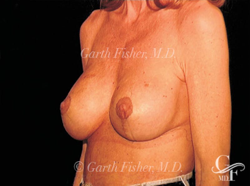 Breast Lift Before & After Gallery - Patient 266841 - Image 4