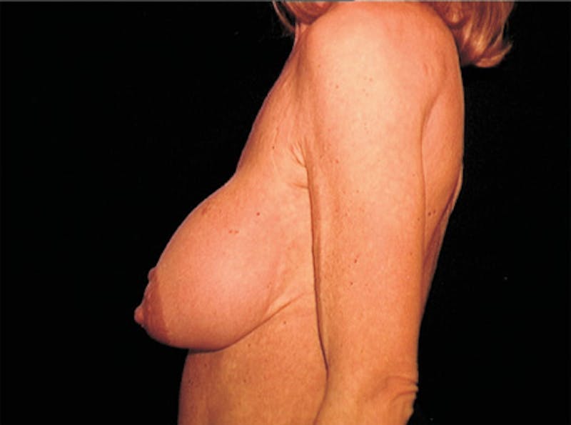 Breast Lift Before & After Gallery - Patient 266841 - Image 5