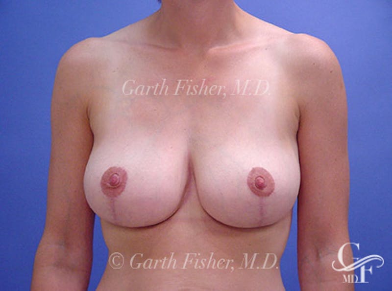 Breast Lift Before & After Gallery - Patient 743902 - Image 2