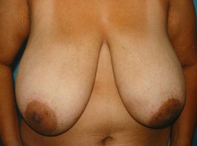 Breast Lift Before & After Gallery - Patient 402263 - Image 1