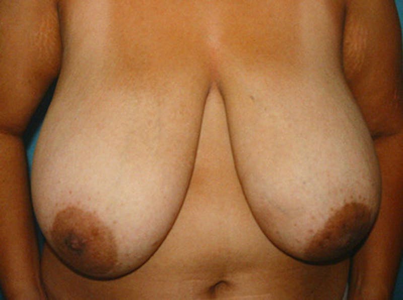 Breast Lift Before & After Gallery - Patient 402263 - Image 1