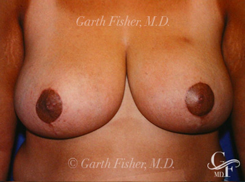Breast Lift Before & After Gallery - Patient 402263 - Image 2