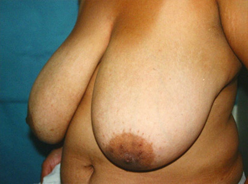 Breast Lift Before & After Gallery - Patient 402263 - Image 3