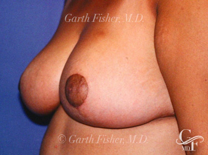 Breast Lift Before & After Gallery - Patient 402263 - Image 4
