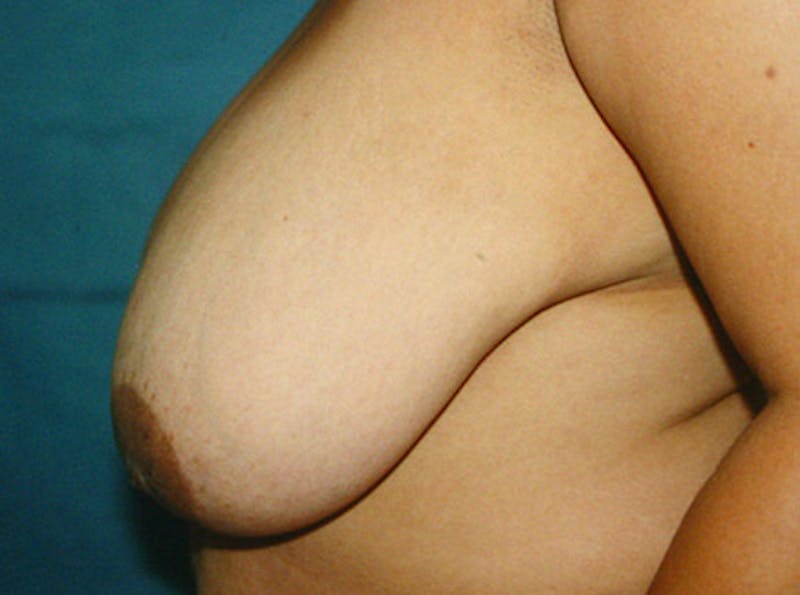 Breast Lift Before & After Gallery - Patient 402263 - Image 5