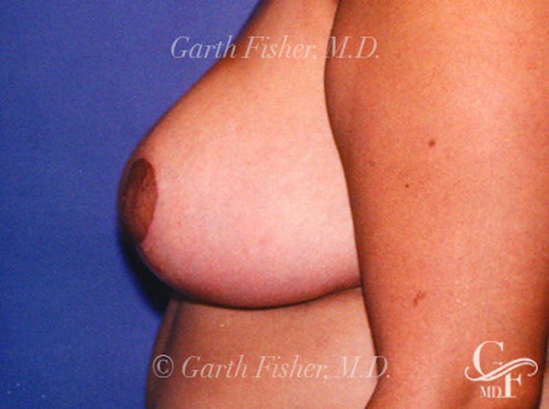 Breast Lift Before & After Gallery - Patient 402263 - Image 6