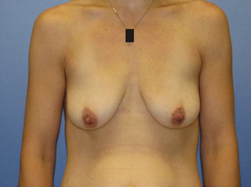 Breast Lift Before & After Gallery - Patient 235814 - Image 1