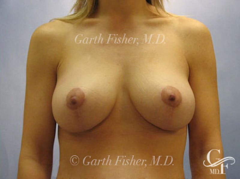 Breast Lift Before & After Gallery - Patient 235814 - Image 2