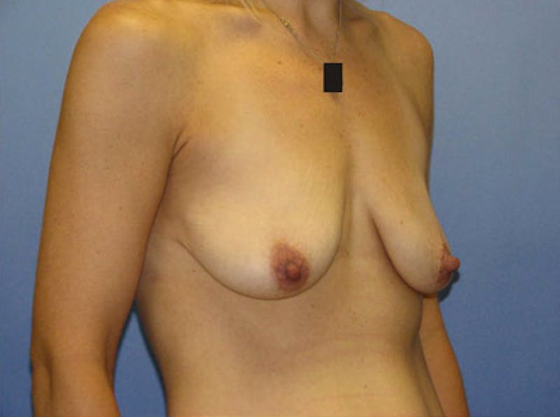 Breast Lift Before & After Gallery - Patient 235814 - Image 3