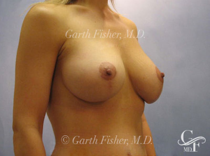 Breast Lift Before & After Gallery - Patient 235814 - Image 4