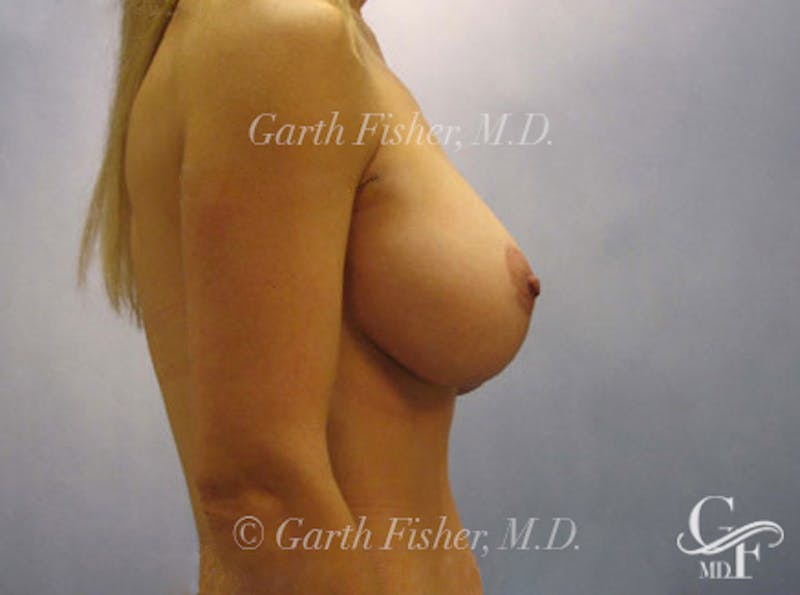 Breast Lift Before & After Gallery - Patient 235814 - Image 6