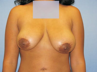 Breast Lift Before & After Gallery - Patient 319719 - Image 1