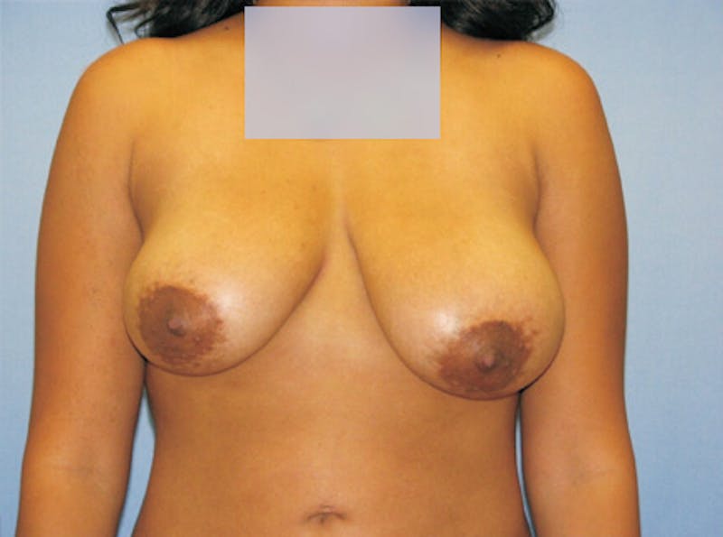 Breast Lift Before & After Gallery - Patient 319719 - Image 1