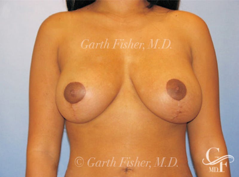 Breast Lift Before & After Gallery - Patient 319719 - Image 2