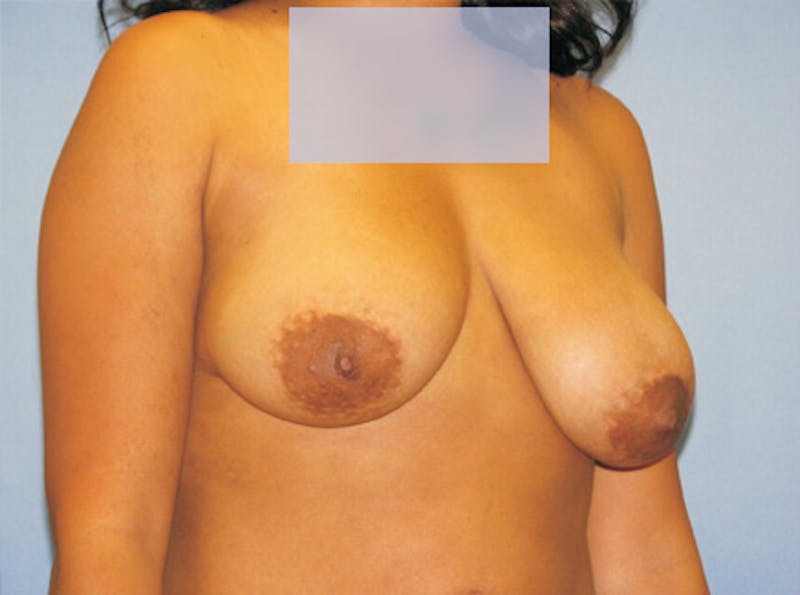 Breast Lift Before & After Gallery - Patient 319719 - Image 3