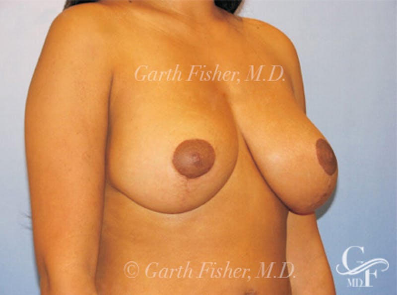 Breast Lift Before & After Gallery - Patient 319719 - Image 4
