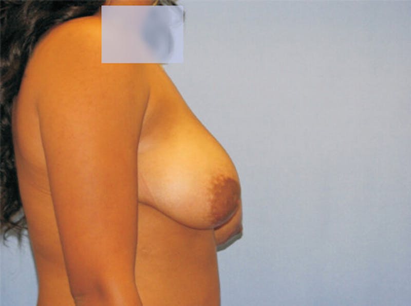 Breast Lift Before & After Gallery - Patient 319719 - Image 5
