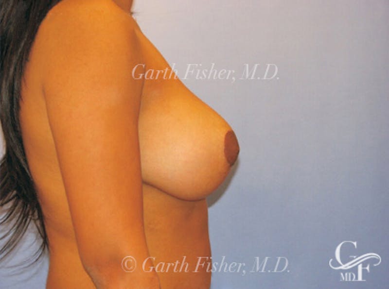 Breast Lift Before & After Gallery - Patient 319719 - Image 6
