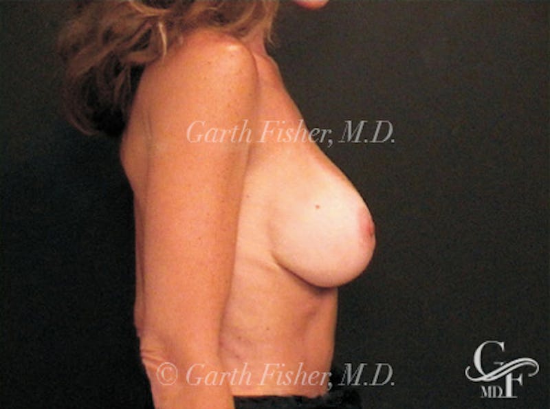 Breast Revision Before & After Gallery - Patient 464380 - Image 6