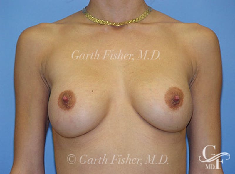 Breast Revision Before & After Gallery - Patient 417404 - Image 2