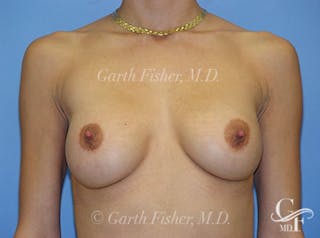 Breast Revision Before & After Gallery - Patient 417404 - Image 2