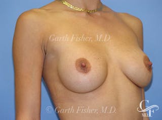 Breast Revision Before & After Gallery - Patient 417404 - Image 4