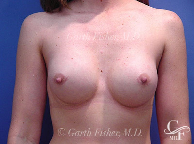 Breast Revision Before & After Gallery - Patient 249591 - Image 2