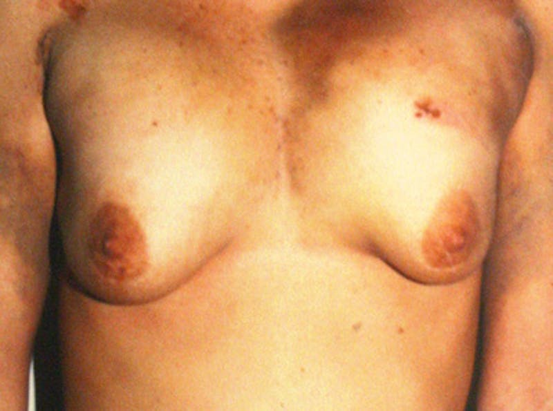 Breast Revision Before & After Gallery - Patient 212574 - Image 1