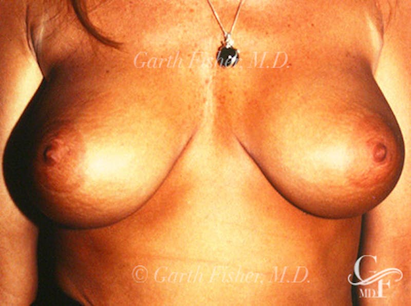 Breast Revision Before & After Gallery - Patient 212574 - Image 2