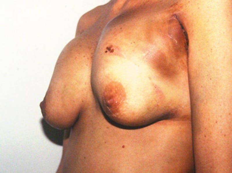 Breast Revision Before & After Gallery - Patient 212574 - Image 3