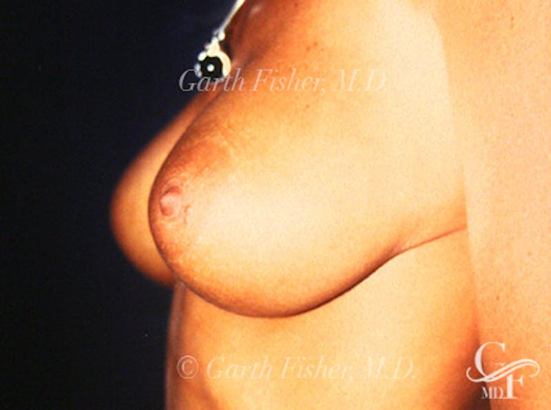 Breast Revision Before & After Gallery - Patient 212574 - Image 4